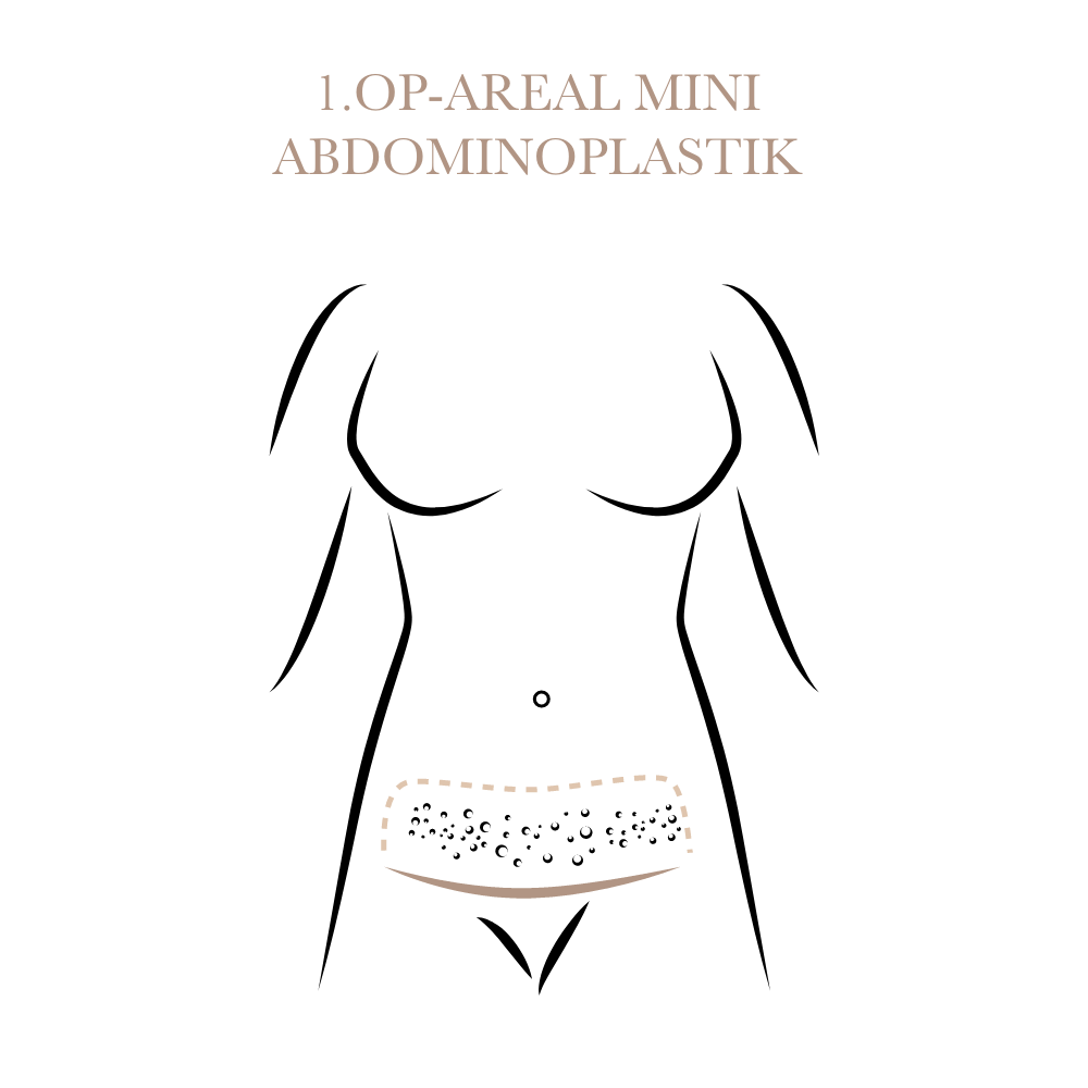 Bauchstraffung Unterbauch mit Entferntem Areal