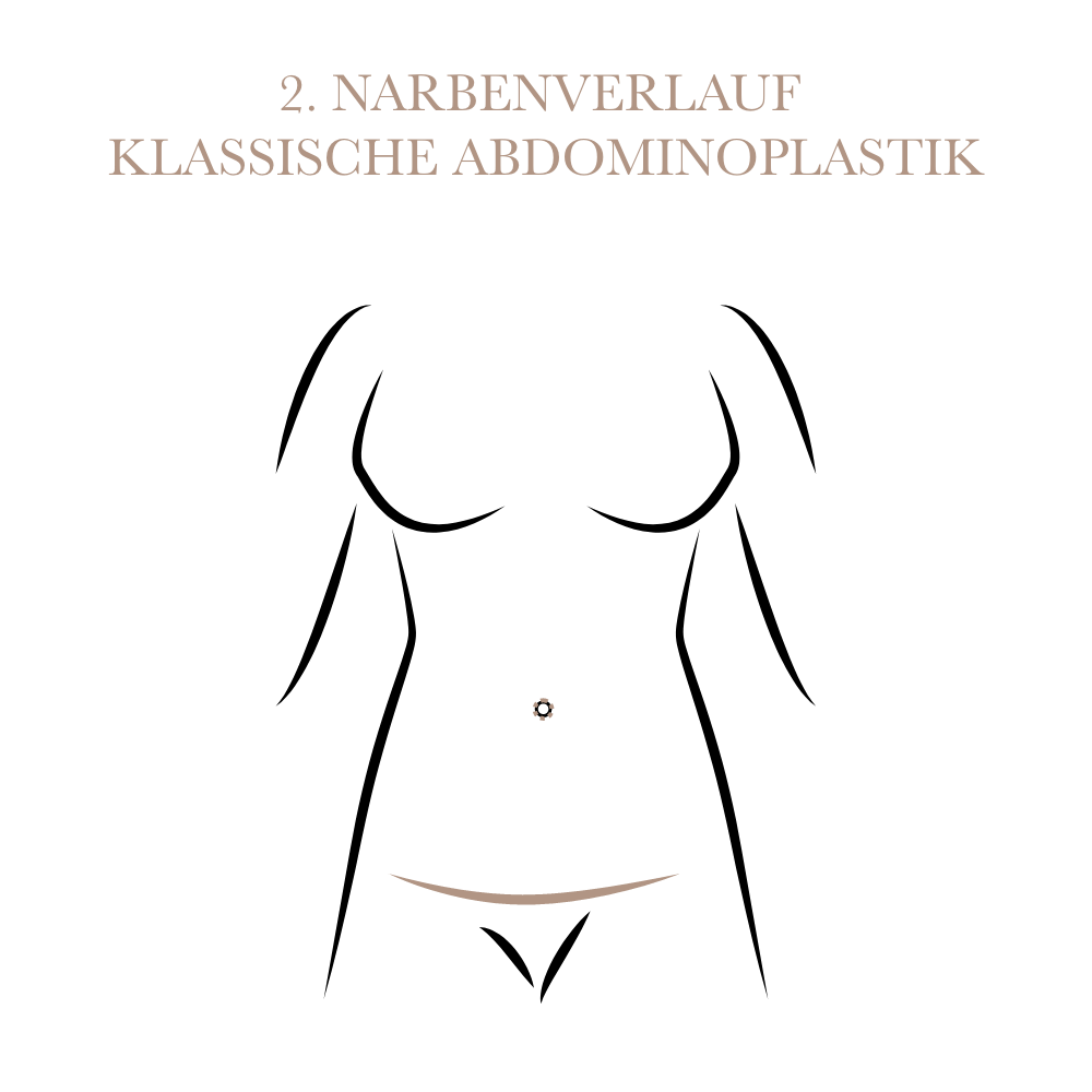Bauchstraffung klassisch