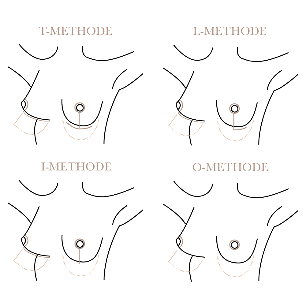 Bruststraffung Narbenverlauf