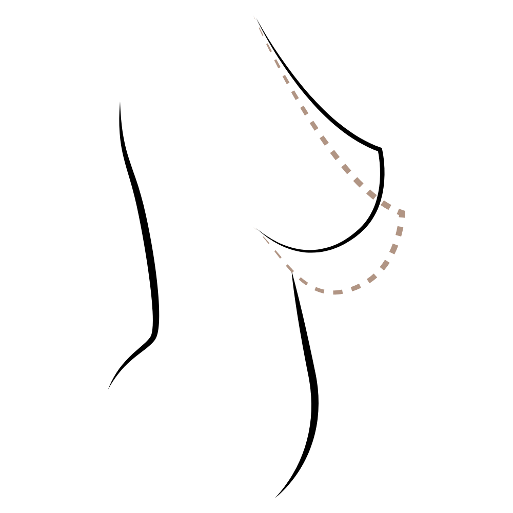 Bruststraffung Übersicht