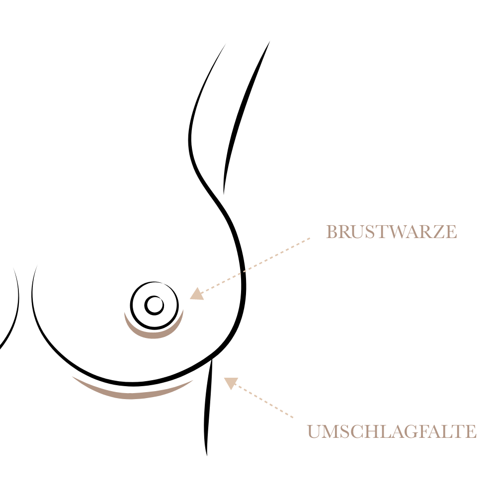 Brustvergroesserung Schnitführung