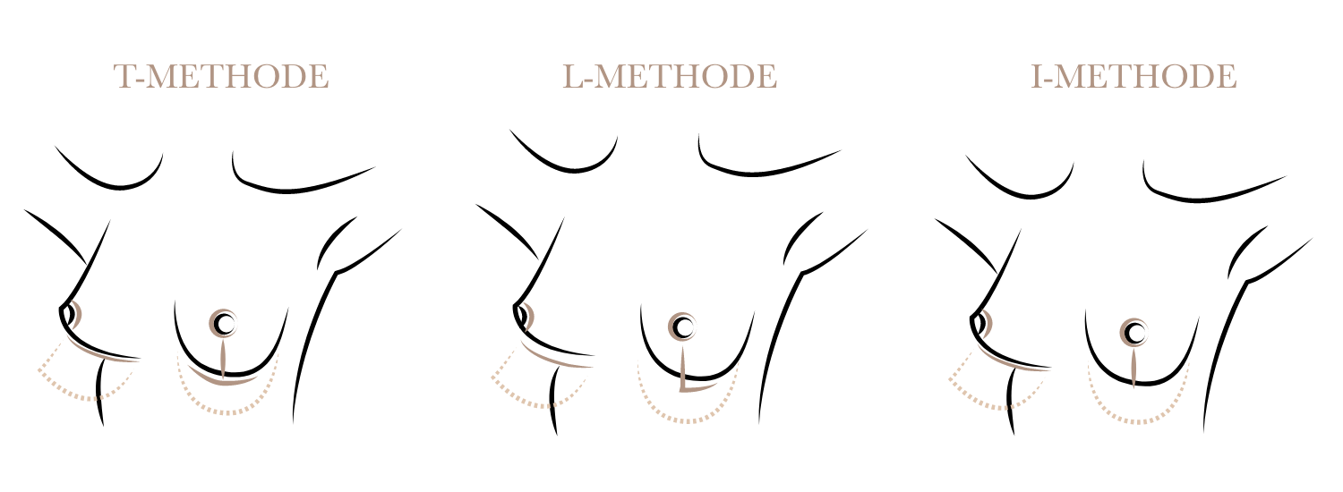 Brustverkleinerung Beschreibung