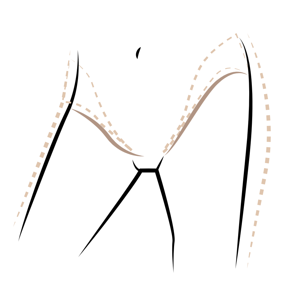 Oberschenkelstraffung-Reiterhosen