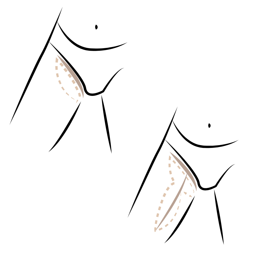 Oberschenkelstraffung-innen