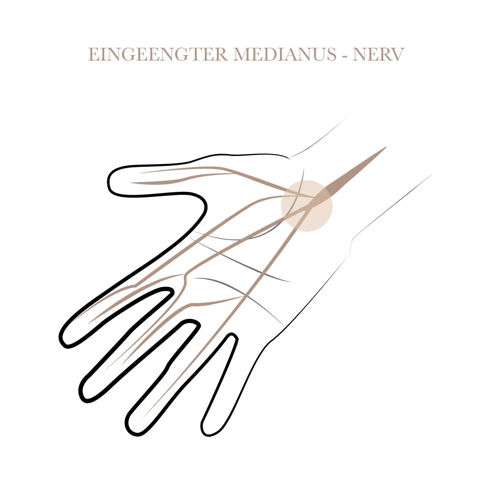 Eingeengter Medianus Nerv