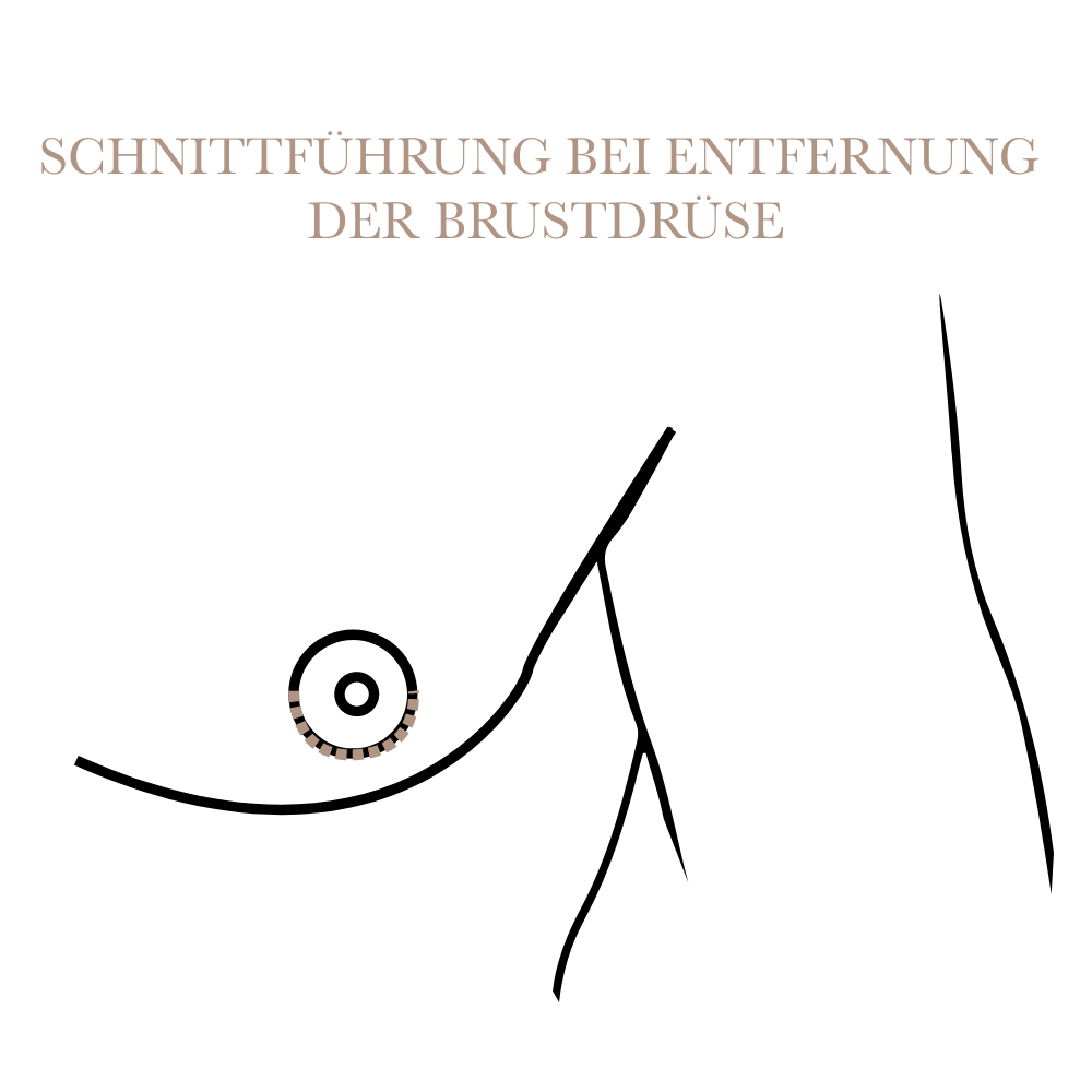 Schnittfuehrung Gynaekomastie