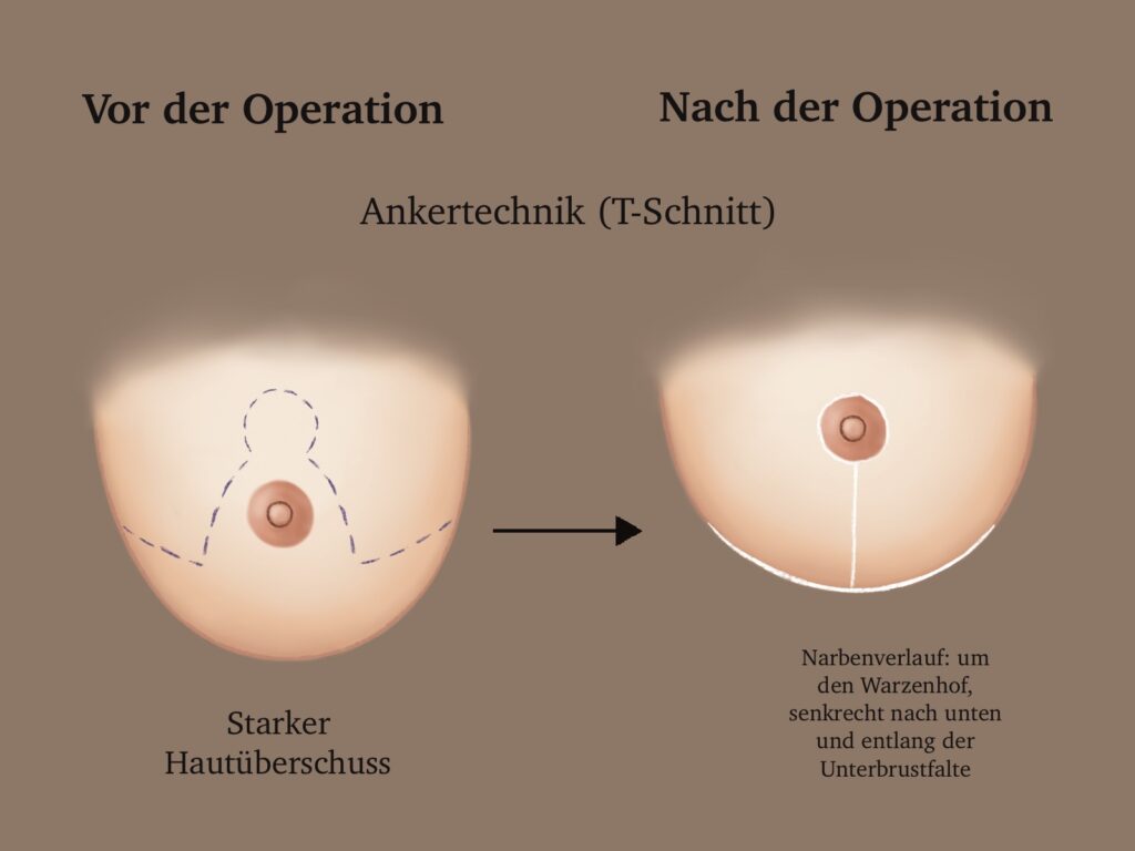 Bruststraffung Ankertechnik