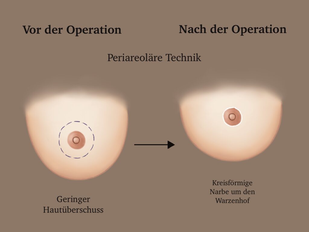 Bruststraffung Periareoläre Technik