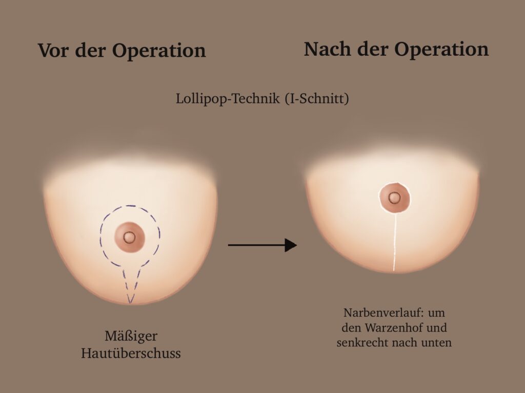 Bruststraffung Lollipop-Technik